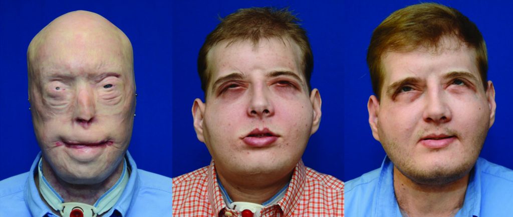 Face transplant