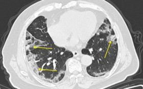 how bad is covid pneumonia in both lungs