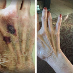 Think Age Spots and Thin Skin Are Forever? Watch This